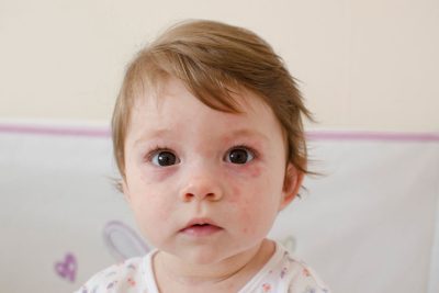 Herpes em bebê