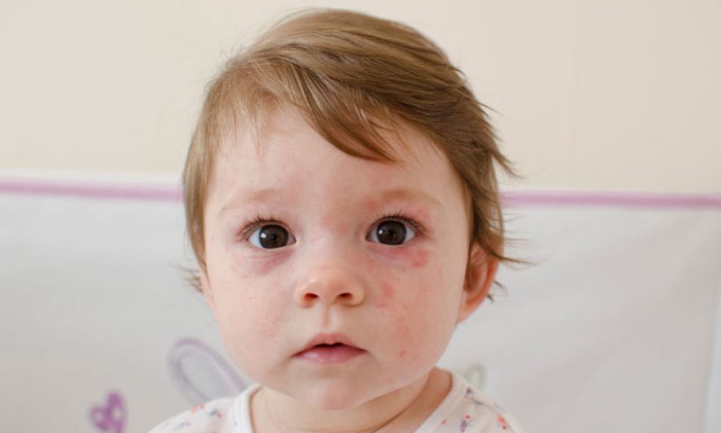 Herpes em bebê