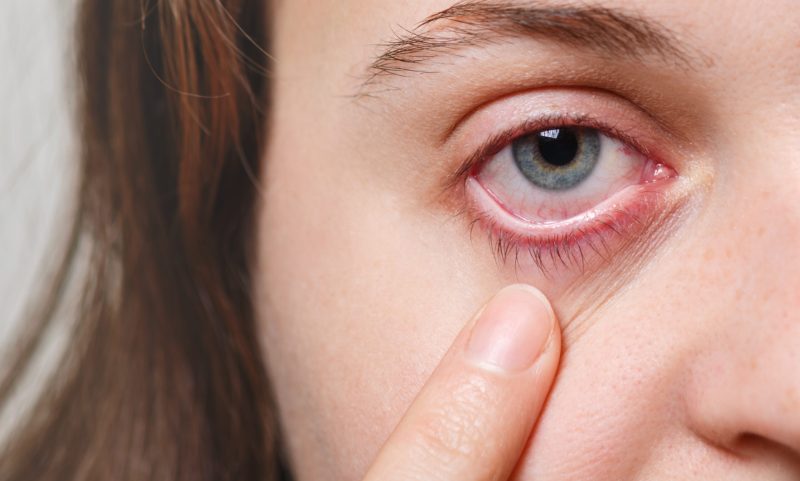 Medicine, health care and eyesight concept. Unrecognizable female shows her inflated red eye with blood capillary, has conjuctivitis. Woman with injured eye