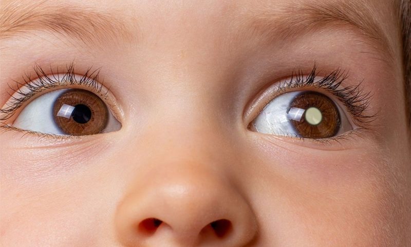 retinoblastoma